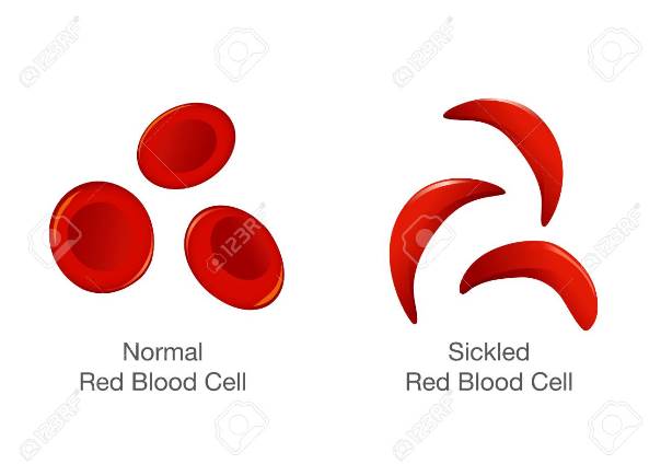 Sickle Cell Anemia is a neglected chronic disorder in India