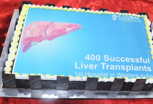 The liver transplant team at Global Hospital, Mumbai, which is the leader in liver transplantation in Western India achieves a significant landmark with the completion of more than 400 transplants, in a span of 6 years. The transplants were performed by the most comprehensive and experienced team with success rates comparable to the best centers in the world. A celebration for this was held at Global Hospital on Friday. The team has several first in Western India to their credit such as the first simultaneous liver-kidney transplant, first swap (pair-exchange) liver transplant, first ABO-incompatible liver transplant, first dual lobe liver transplant, and first auxiliary liver transplant performed in Western India. One of the critical aspects of a liver transplant is a thorough evaluation and appropriate selection of patients and donors to ensure their suitability for a safe operation. The team has 100% a track record for donor safety because of the rigorous processes that are followed to ensure early and healthy donor recovery. In situations where the patient is unable to undergo a transplant because of reasons such as for overweight or incompatible blood group of the donor, the team circumvents these limitations by offering innovative techniques such as dual lobe transplant or ABO-incompatible transplant, which is offered at few centers in India. The team’s results are also due to the state-of-the-art equipment, instruments, and dedicated ICUs for liver failure patients and liver transplant patients with experienced staff for care before, during, and after the transplant. With advanced monitoring facilities and equipment, the team is able to handle any changes in the patient’s vital parameters and stabilize them during the transplant. Patients with liver failure often require medical stabilization before the transplant and intensive care after the transplant. Using some of the latest protocols for liver failure, several patients have recovered from liver failure in the ICU without a transplant. The team has also performed the largest number of pediatric liver transplants in western India. In children, a liver transplant is often required for genetic diseases leading to bile duct not being formed properly or liver cancer. A liver transplant could be challenging in children because of the small size of blood vessels and structures that need to be joined during the surgery. Dr. Ravi Mohanka, Chief Surgeon and Head of Department, Transplant and HPB Surgery, Global Hospital, Mumbai said “Most commonly patients undergoing liver transplants were about 45 – 55 years old requiring transplants due to end-stage liver disease due to hepatitis B or C infection, alcoholic liver disease, fatty liver disease, or liver cancer. The oldest patient to receive a transplant at our center was 80-year-old at the time of transplant and doing well at 3 years now. We have also performed a transplant on a baby weighing only 4.7 kgs, the lightest in western India”. Dr. Samir Shah, Head, Department of Hepatology, Liver Intensive Care and Transplant Hepatology, Global Hospital, Mumbai said “At the Global Mumbai, we have been able to fulfill an unmet need in western India of a center of excellence offering complete liver care. The hospital also offers fellowship training programs in liver transplant, hepatology and liver anesthesia, and critical care”. I would like to congratulate all members of the transplant team who have contributed to the development of the most comprehensive liver transplant program in Western India. The multi-disciplinary approach has enabled the team at Global to offer 360-degree liver care to patients. Reaching this significant milestone is a reflection of incredible teamwork, passion, and dedication of the team who care for our patients each day. Being the leader in organ transplant in Western India in terms of clinical outcomes and in volume places a responsibility on us to bring the latest techniques enhanced skills and to maintain our patient care on par with international standards, concluded Dr. Vivek Talaulikar, Chief Executive Officer, Global Hospital, Mumbai.