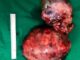 Apex Superspeciality Hospitals doctors remove 3 Kg tumour from chest after 6 hours of surgery