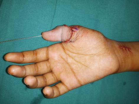 When Can a Severed Finger Be Reattached?