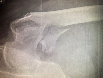 Zen Multispeciality Hospital Performed a Successful Proximal Femoral Nail Procedure On A Nonagenarian 100-year-old Woman With Hip Fracture