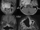 X-Ray of the Nasal Tumor