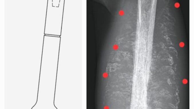 Apollo Cancer Centres, performed a unique and complex limb salvage surgery to treat a case of Osteosarcoma to remove cancer and reconstruct with custom growing prosthesis in the left thigh