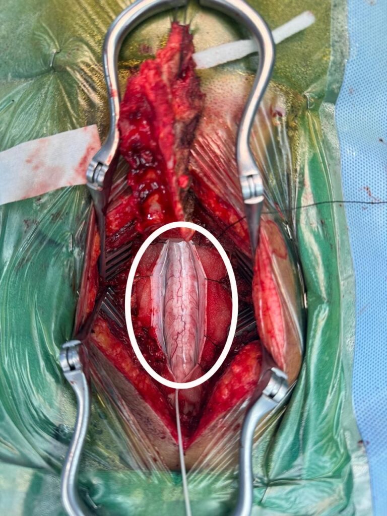 Inside the spinal cord there was a tumour