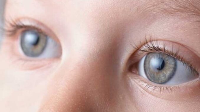 Cataract in Children