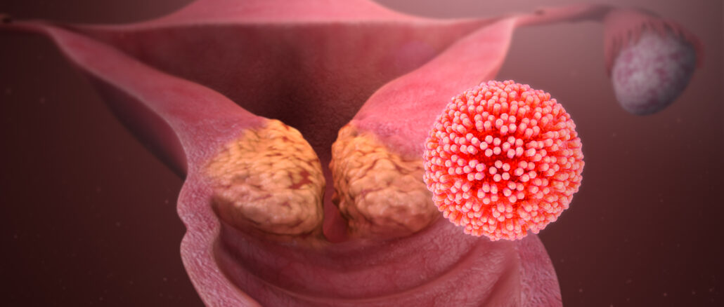 Nasal Therapeutic Vaccine