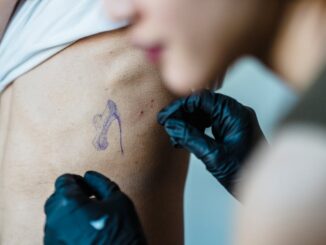 professional laser tattoo removal