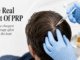 PRP Therapy For Hair Loss